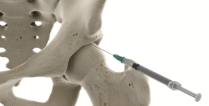 artrose no quadril